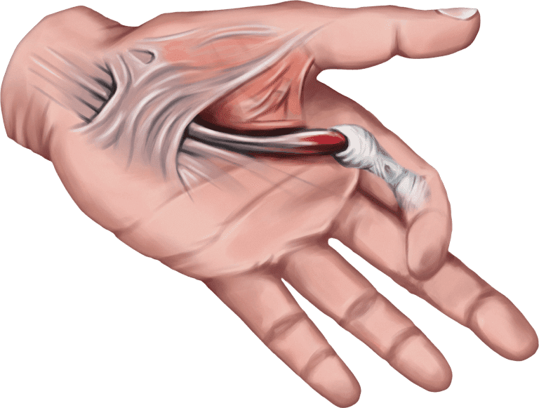 Relative motion flexion splint for ring finger. (A) Dorsal view, (B)... |  Download Scientific Diagram